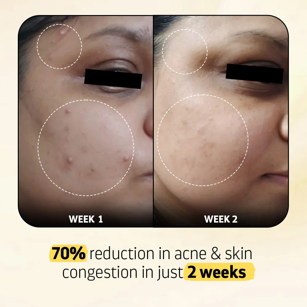 Heads Off - Anti Acne Serum
